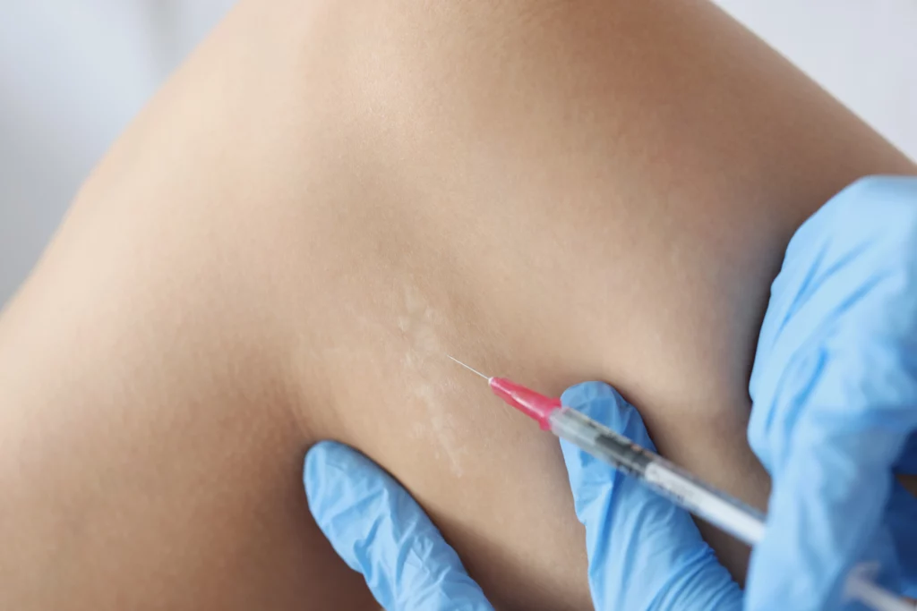 Keloid Scar Injection