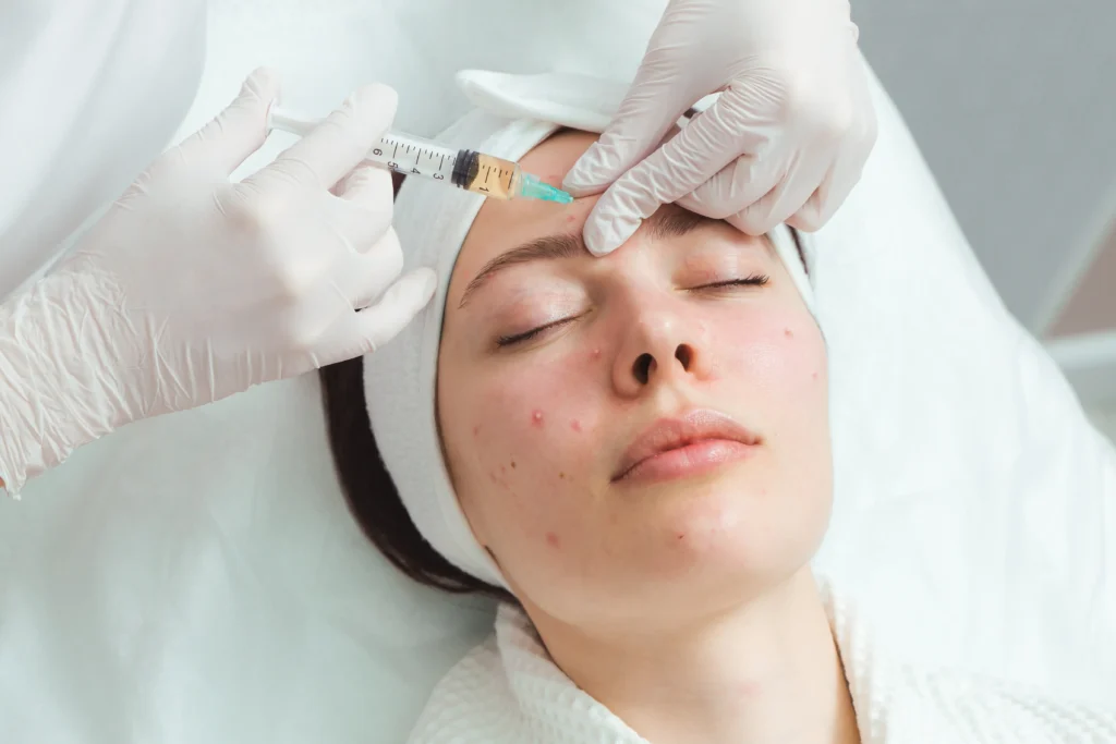 Acne Injection 1 point